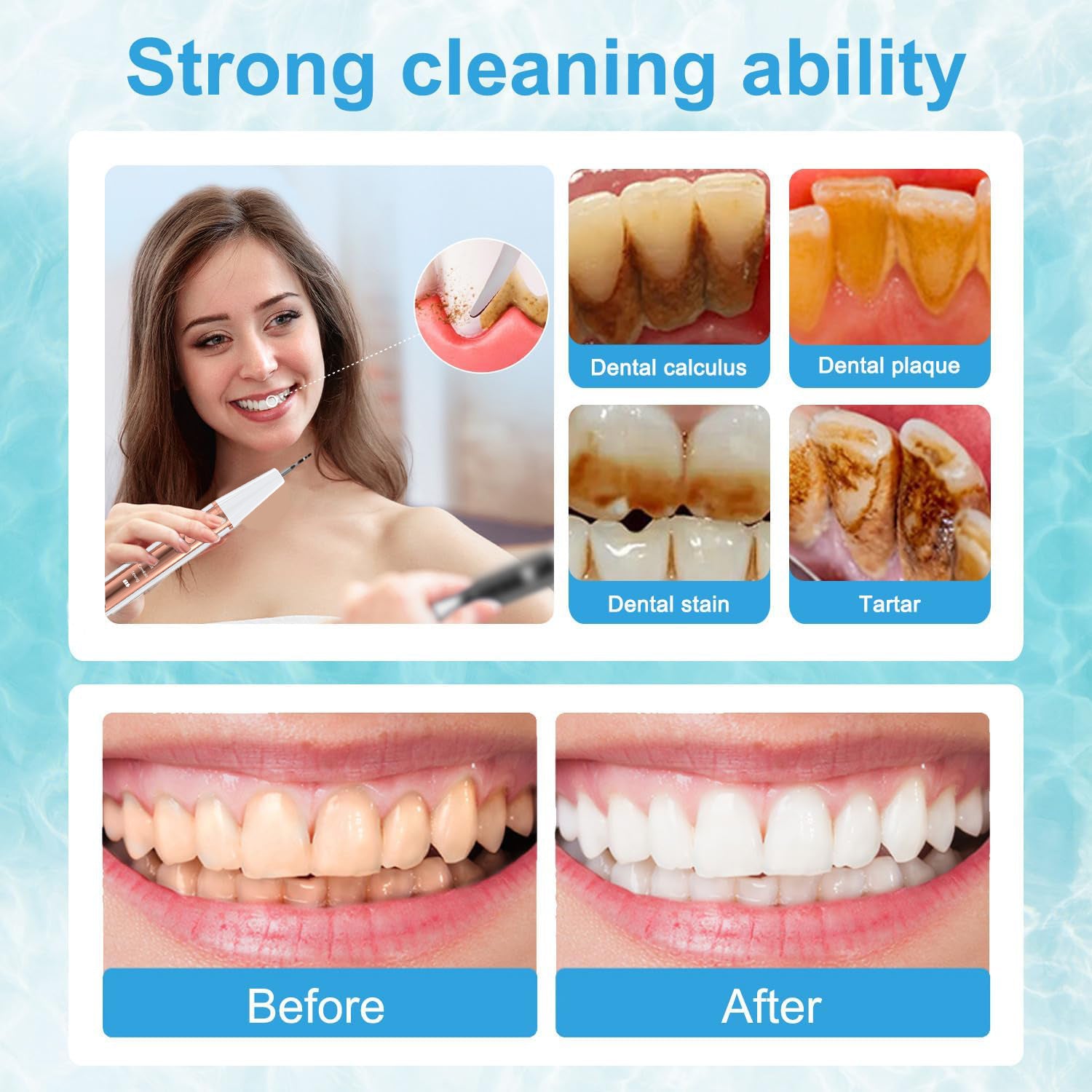Ultrasonic Dental Scaler Kit - Home Use Teeth Cleaner &amp; Tartar Remover-Oral Care-PEROZ Accessories